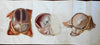 Illnesses of Newborn Children 1868 Valleix French medical book color plates
